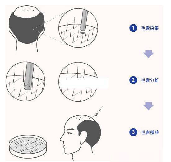 人体普拉朵植发丨植发可以用别人的毛囊吗？