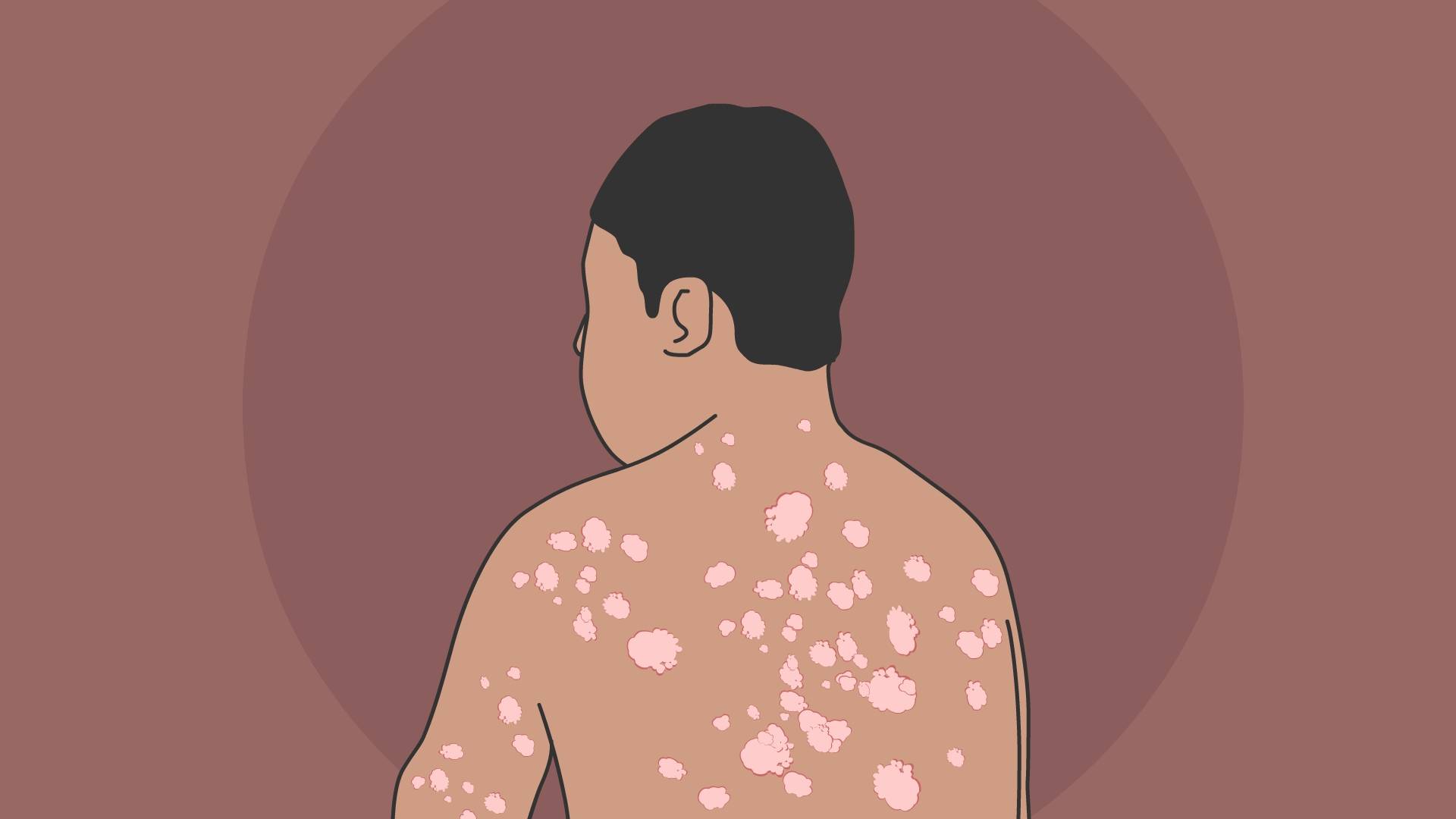 长春肤康医院浅谈:牛皮癣是否具有遗传性?