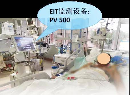 动态|无辐射“动态CT”助力救治多名重症患者