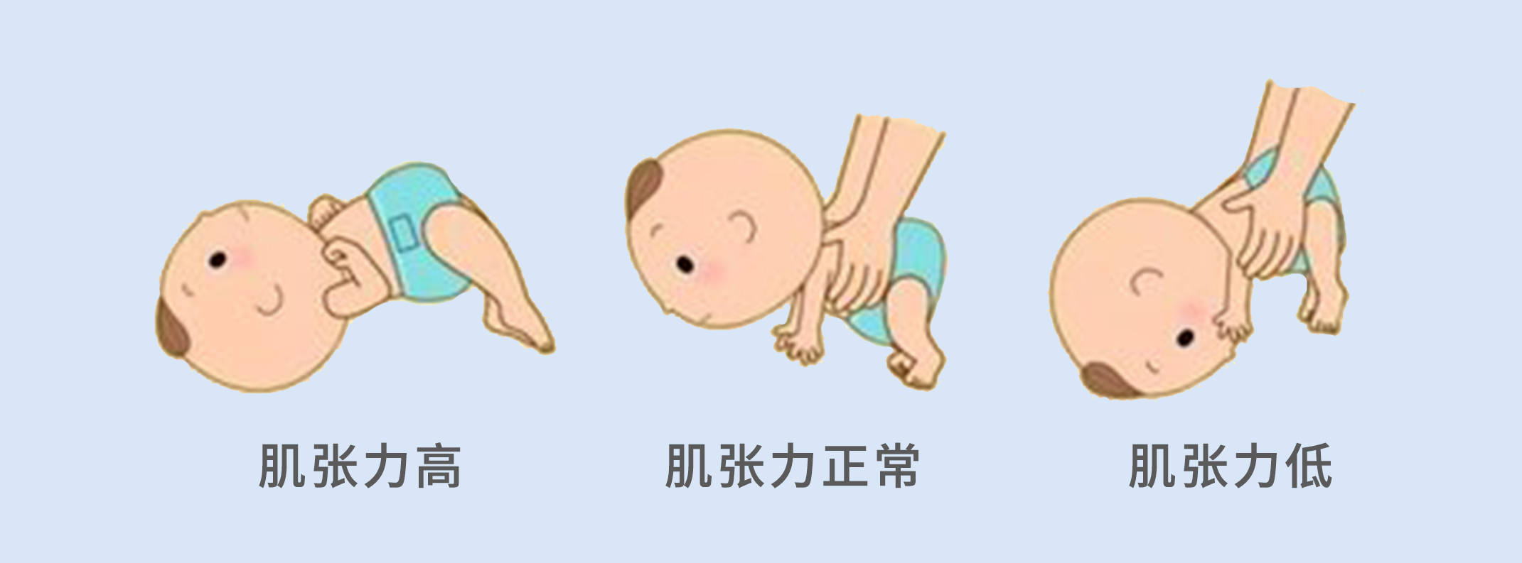 婴儿背部肌张力高图片图片