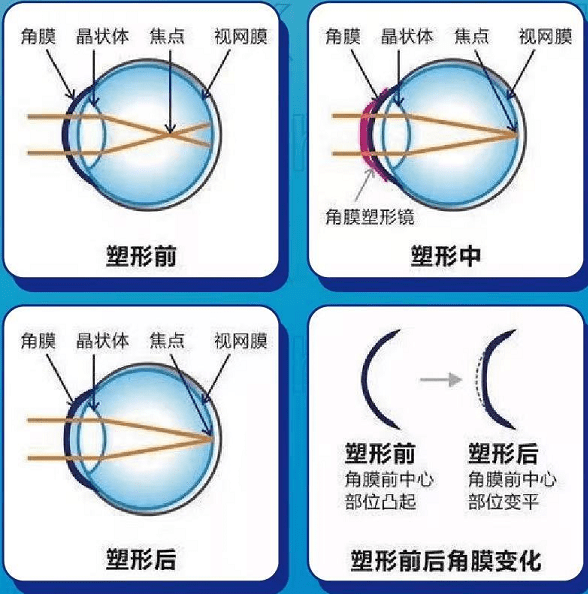 科视眼科角膜塑形镜为什么能控制近视进展