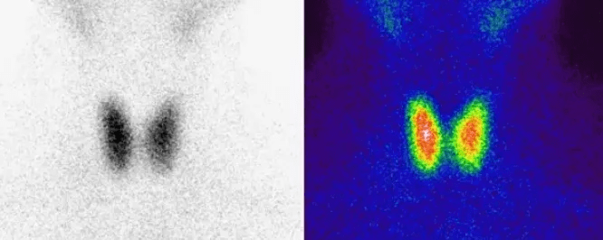 明显降低|季节更替感冒频发，当心 “亚甲炎”找上门！