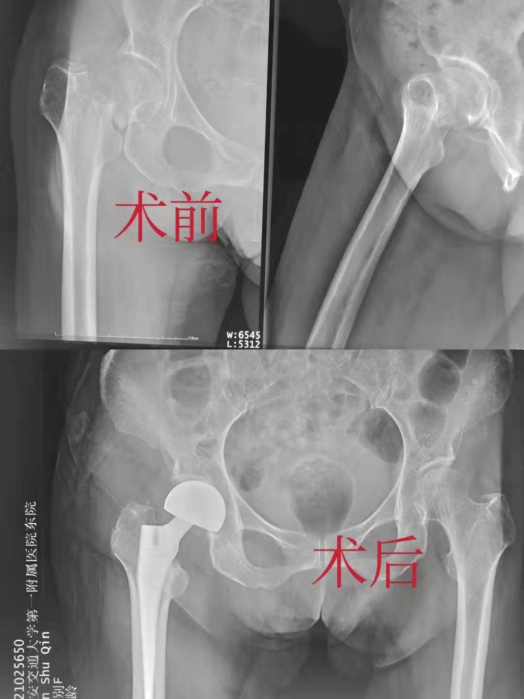 手术|西安交大一附院东院区骨科开通“老年髋部骨折绿色通道”