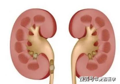 症状|肾病发生时,身体会出现4个“信号”,请自查