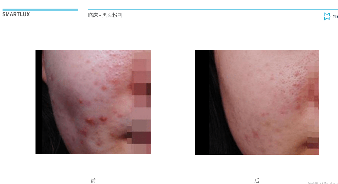 吃什么祛痘痘最快最好 29ccb709f00b4193b187e5030a927235.png
