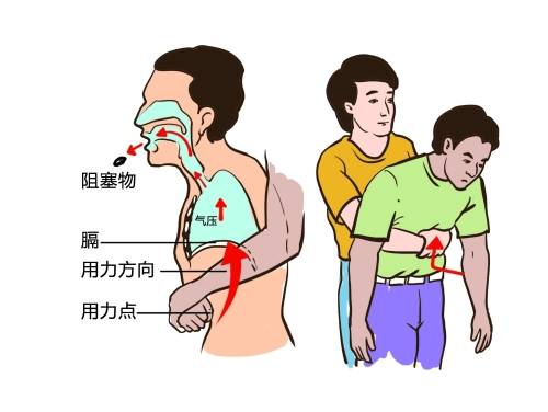 還有人不知道海姆立克急救法嗎家裡有小孩的一定要學