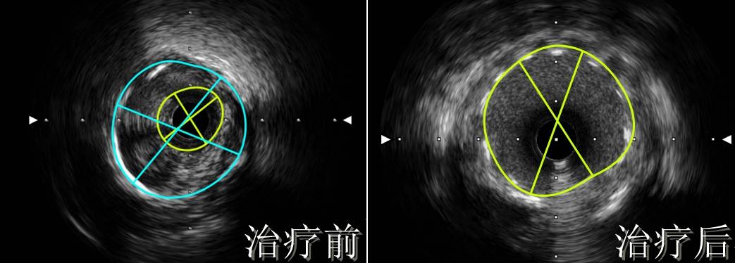 冠脉|确诊冠心病，治疗陷“两难”？极低剂量造影剂置入支架