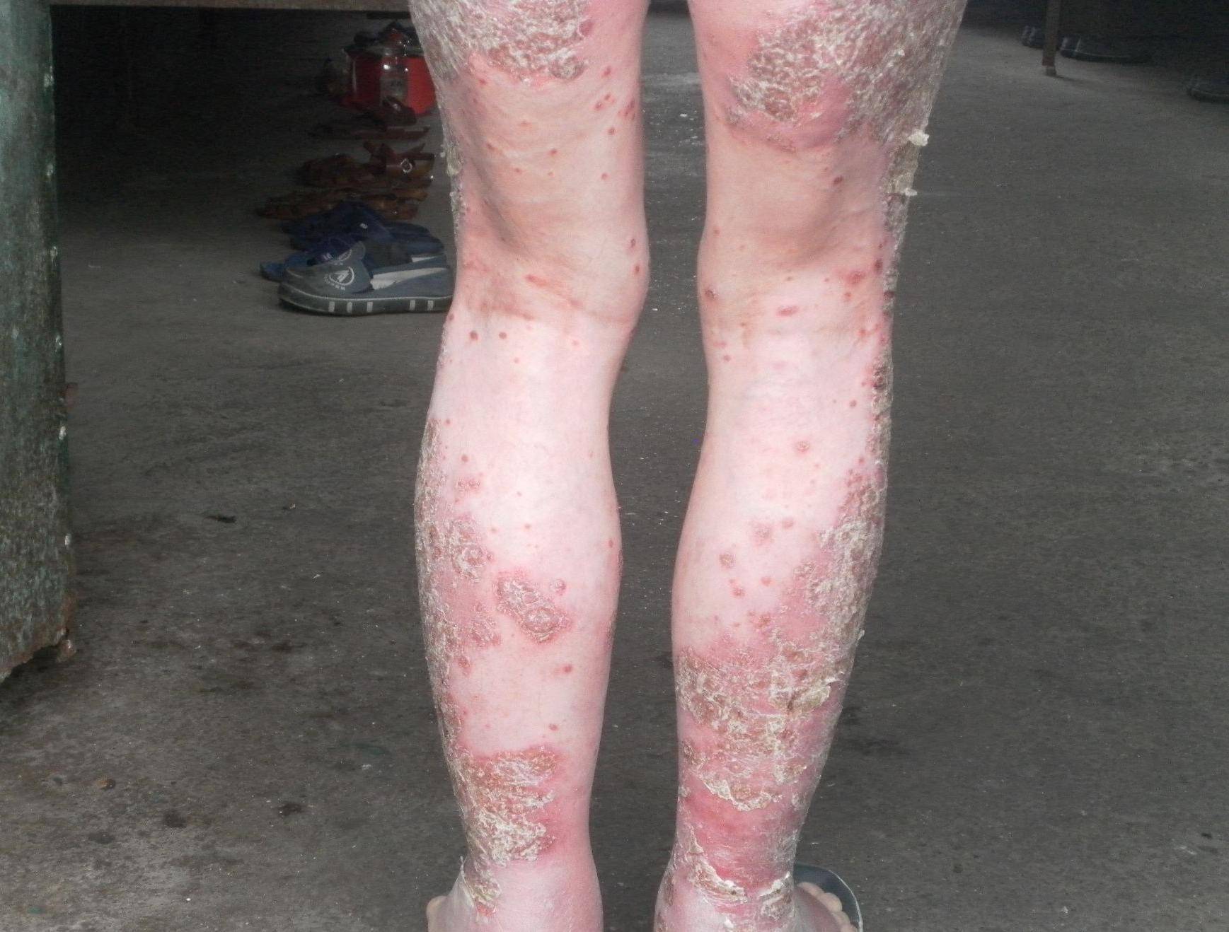 长春肤康医院浅谈:牛皮癣易在哪些部位发作?_患者