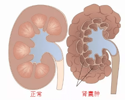 治疗|肾结节，你了解吗？