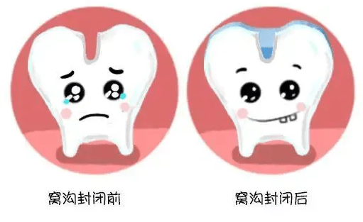 孩子牙齒變黑一定是齲齒嗎?