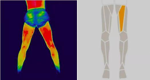 红外热成像在运动康复中的应用_人体_温度_对称性