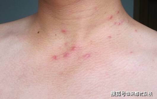 世界艾滋病日街上被针扎会感染上艾滋病吗