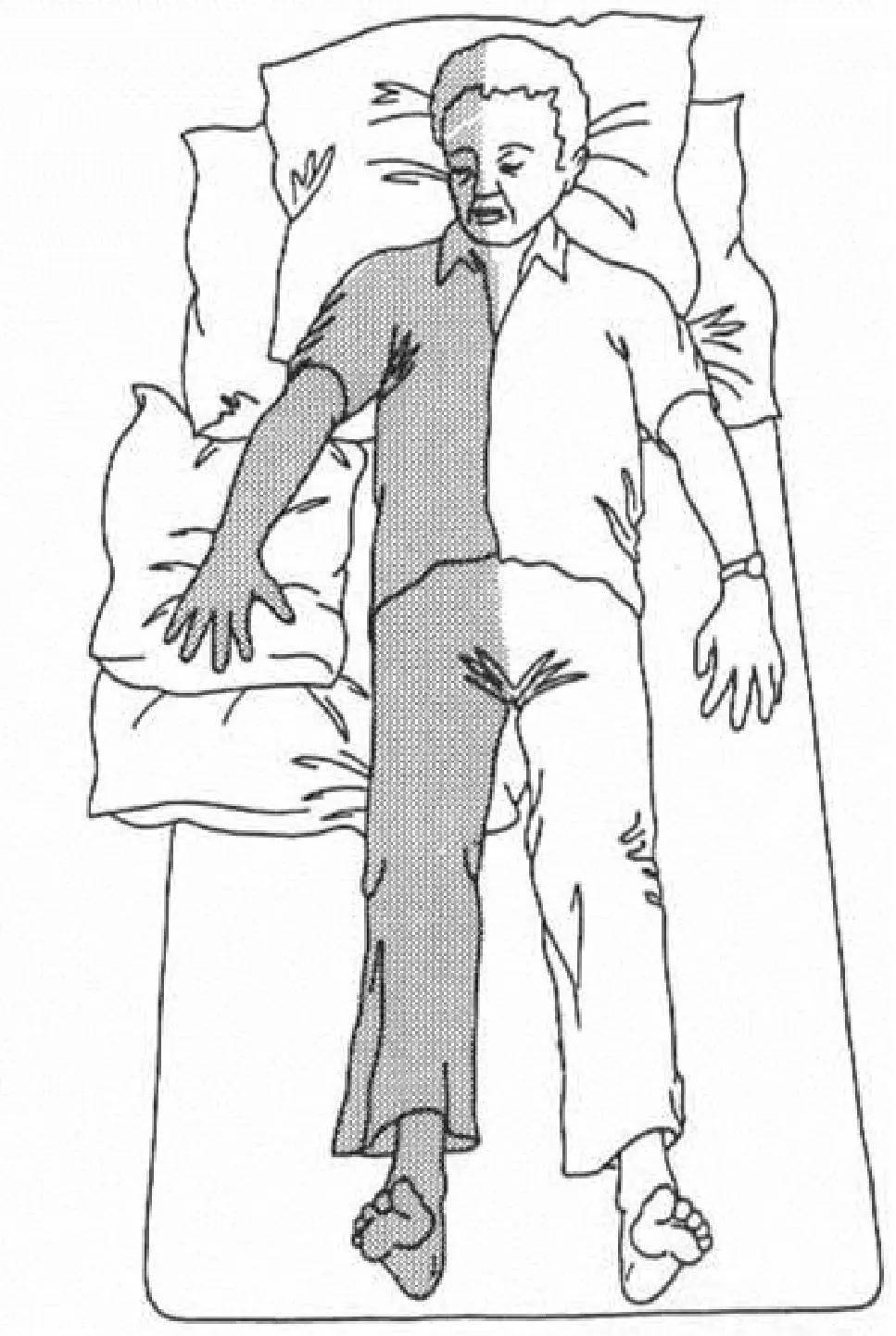 症状|中风偏瘫后能活多久?