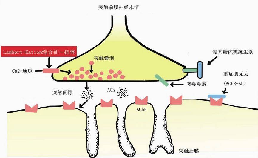 重症肌無力和眼瞼下垂的區別_病變_症狀_交感神經