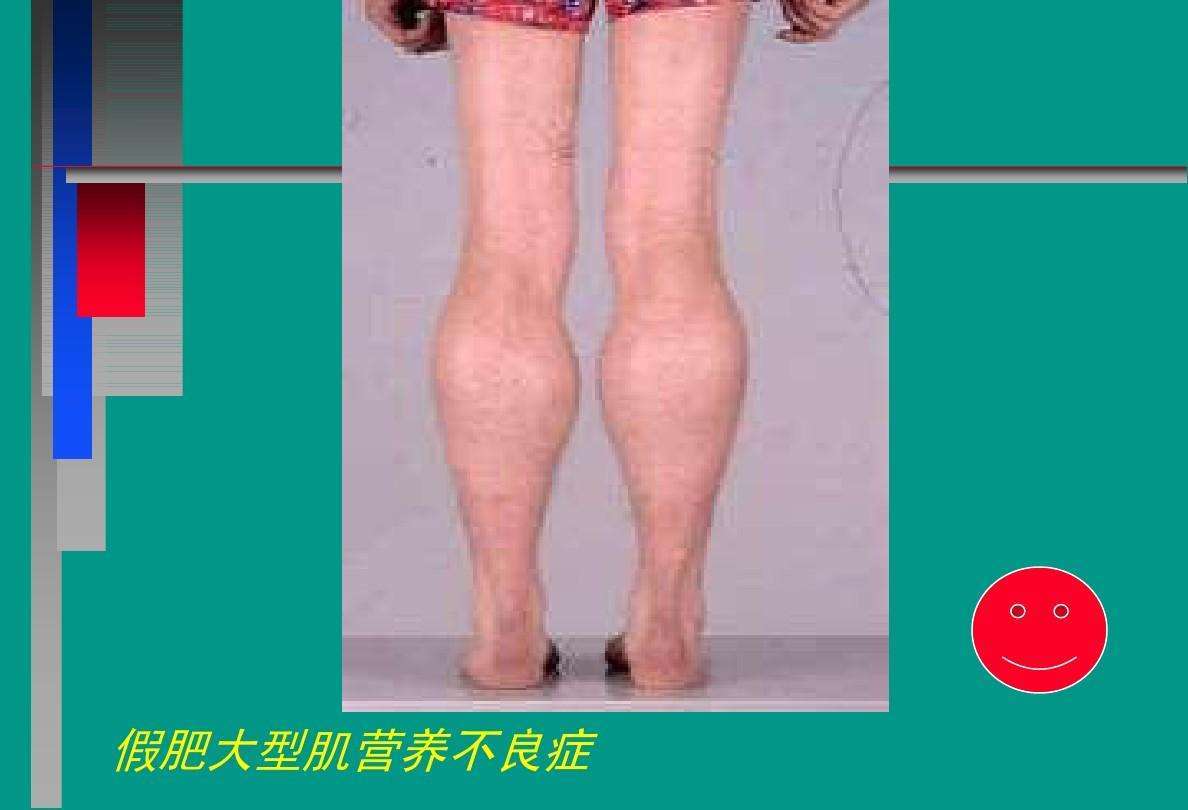 肌营养不良分类有哪些_患者_症状_遗传