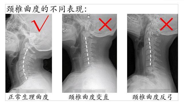 人体|为什么有的人在坐着时，或睡觉翻身时骨头会嘎吱嘎吱响？