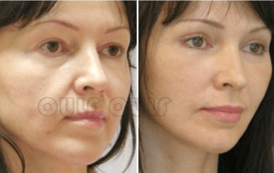 能量线雕手术后几天才可以恢复好、全脸线雕多久完全恢复