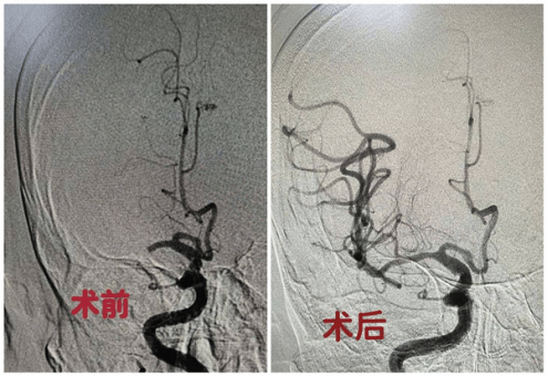 瞿慧阳|85岁老人突发脑梗命悬一线，西安交大二附院开启绿色通道30分钟成功取栓