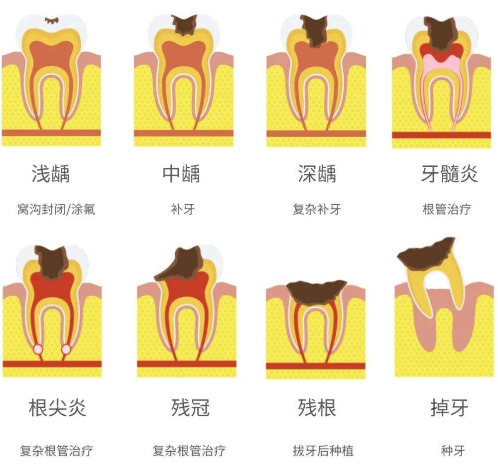 龋齿的形成过程图片图片