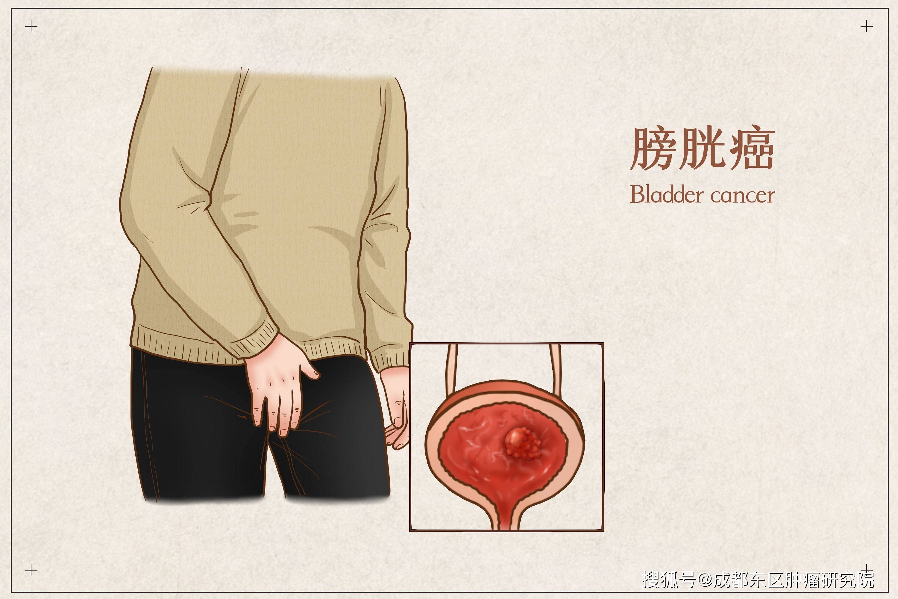 膀胱癌治疗放化疗和中医怎么选择?