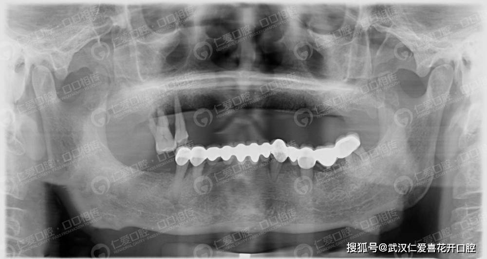 梦回现实，献血之梦与牙落之兆的深层解析