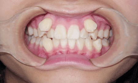虎牙长在牙龈上方图片图片