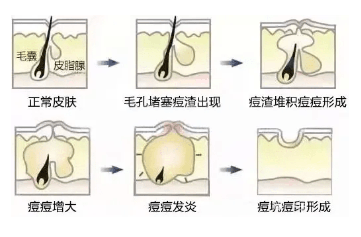 了真痘疤|痘印痘坑形成的原因