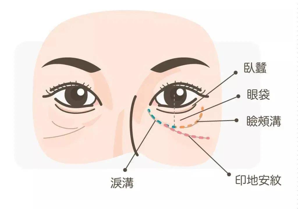 视觉去除印第安纹疼吗？Summerccici老师告诉你