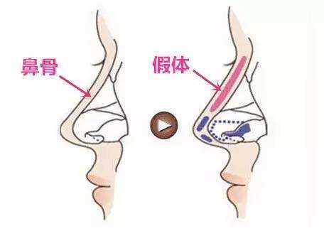 foho鼻综合要多久才能完全恢复