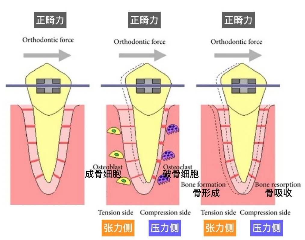 簡單來說就是:牙齒受力→傳遞給牙槽骨→牙槽骨吸收加再生→牙齒移動