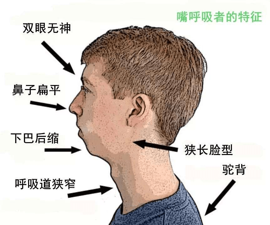 长期嘴巴呼吸后果图片图片