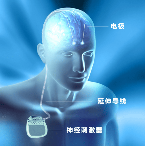 神奇的脑起搏器