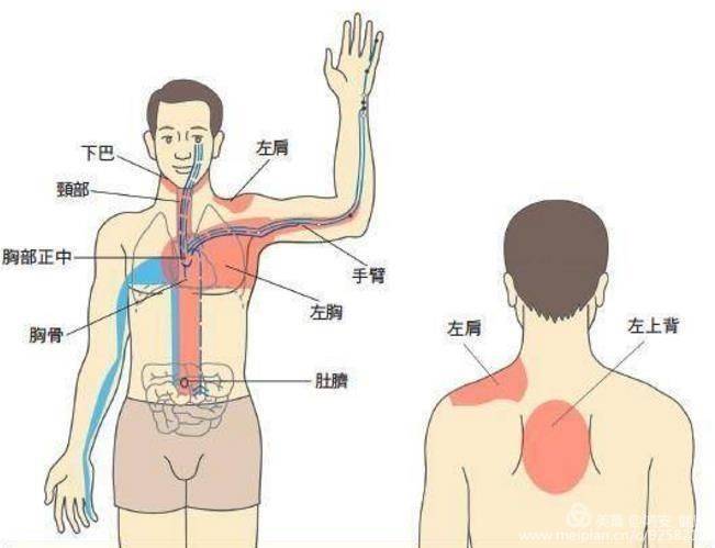 的典型症狀,表現為心前區疼痛或憋悶,疼痛或憋悶的部位主要指胸骨後方