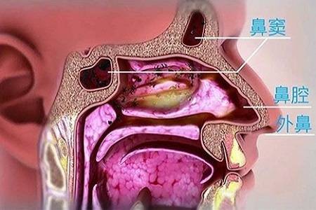 什么叫副鼻窦炎 来自搜狐网