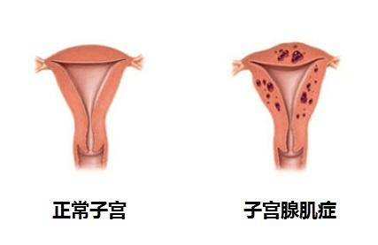 子宮腺肌症專用貼痛經有用嗎