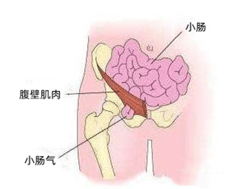 治疗小儿疝气，安全最重要