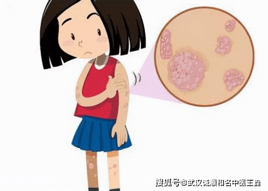 皮肤上起褐色斑块表面粗糙痒_武汉皮肤病专科医院