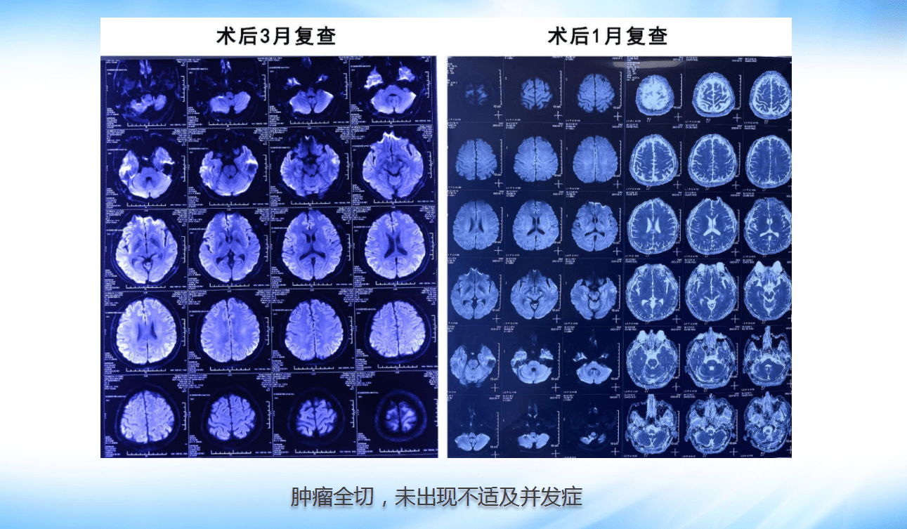 膽脂瘤治療原則:早發現,早手術顱內膽脂瘤又稱表皮樣囊腫,屬良性,起