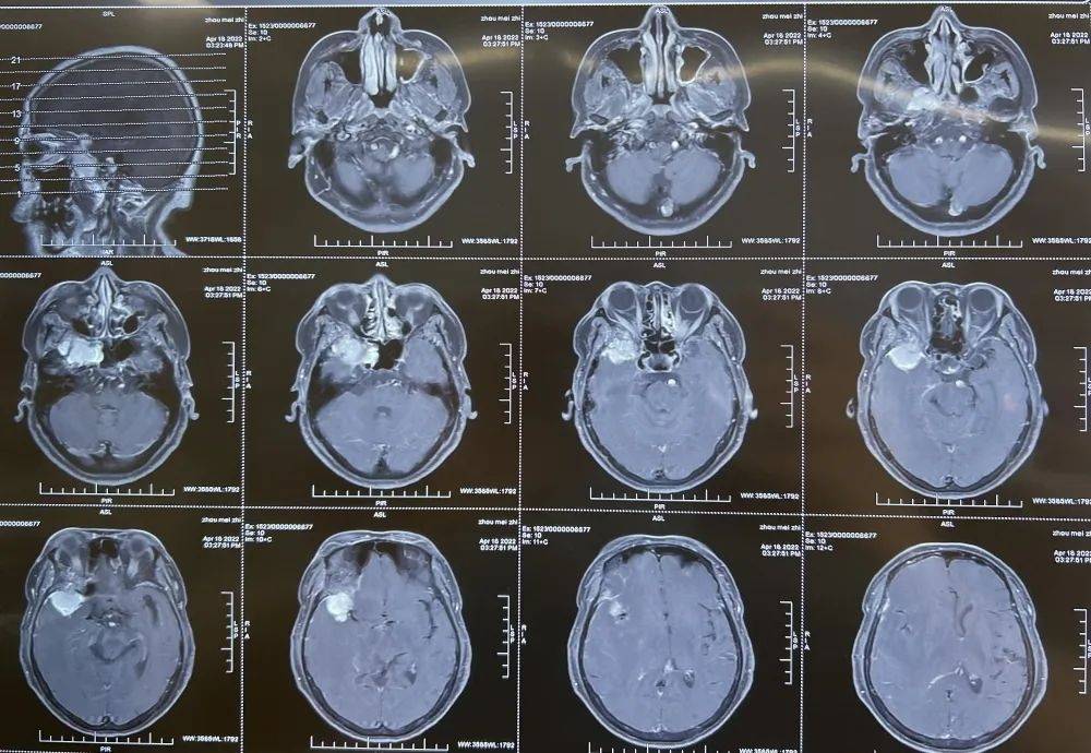 頭顱磁共振平掃 增強,顯示患者頭部右側中顱窩底顱內外溝通瘤,腦膜瘤