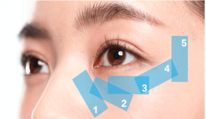 强脉冲光ipl联合睑板腺按摩治疗干眼