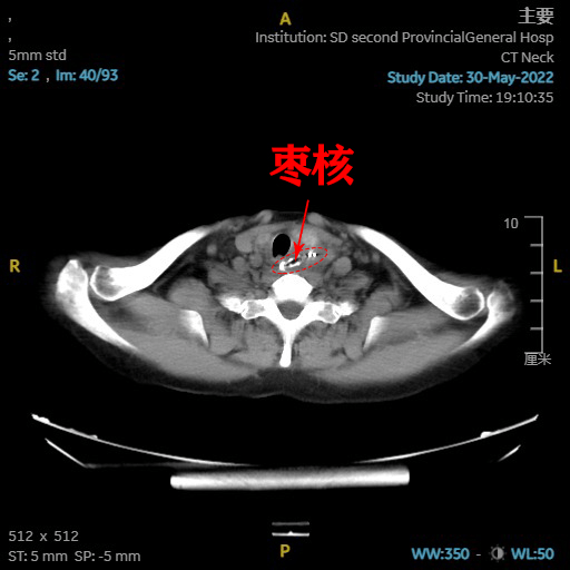 咽喉科主任崔鹏为赵先生安排了ct检查,结果显示,枣核卡在了食管上段