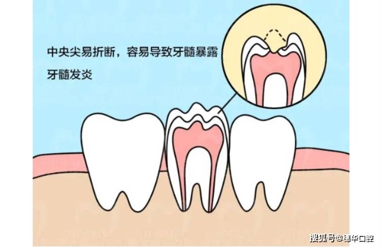 孩子恆牙萌出時,中間冒出一個白色