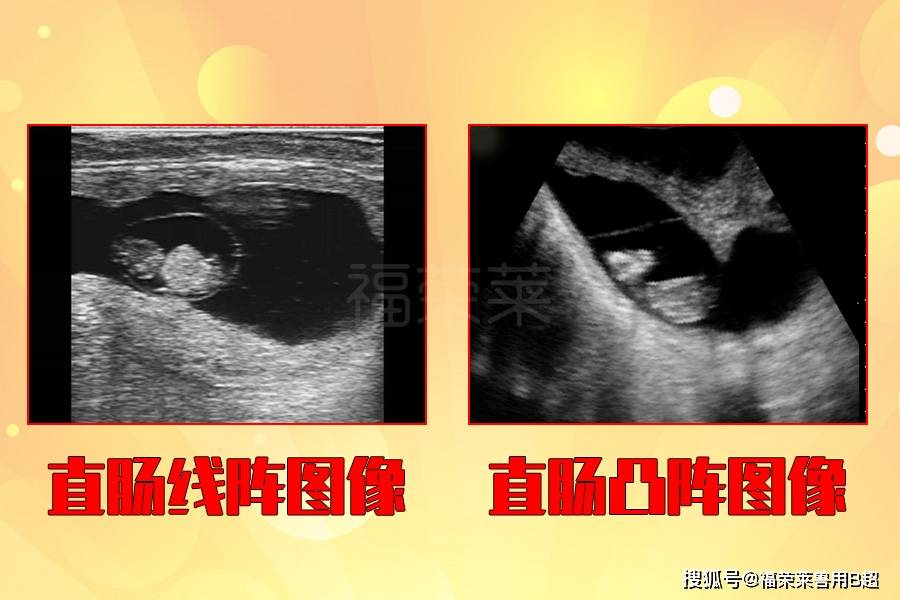 疤痕妊娠b超图片图片