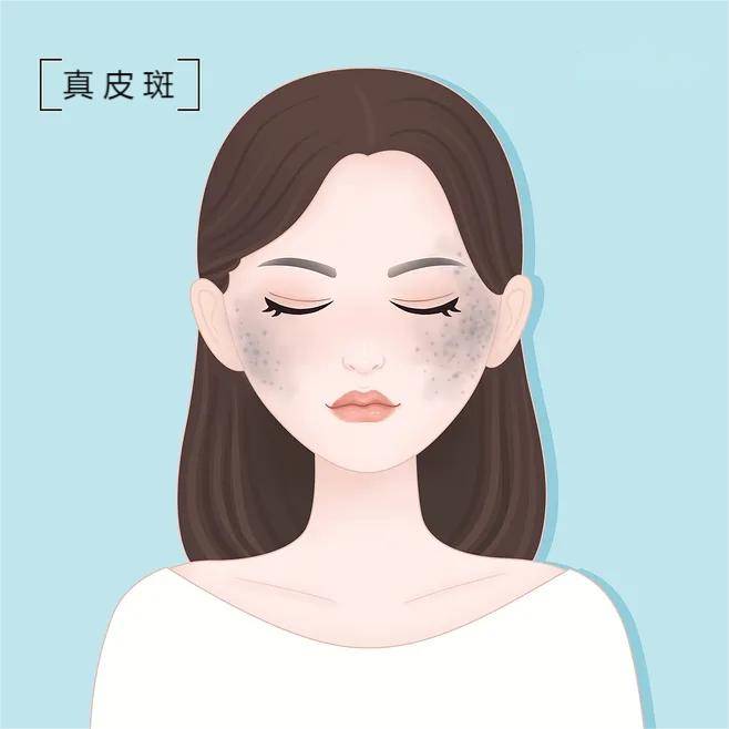 脸上有这6种斑的人要注意下斑不难关键是
