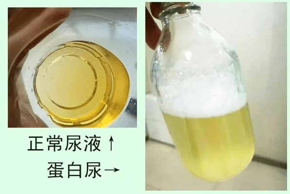 24小时尿的采集留取方法1,晨起后嘱患者排尿后留尿,一般在早晨7时开始