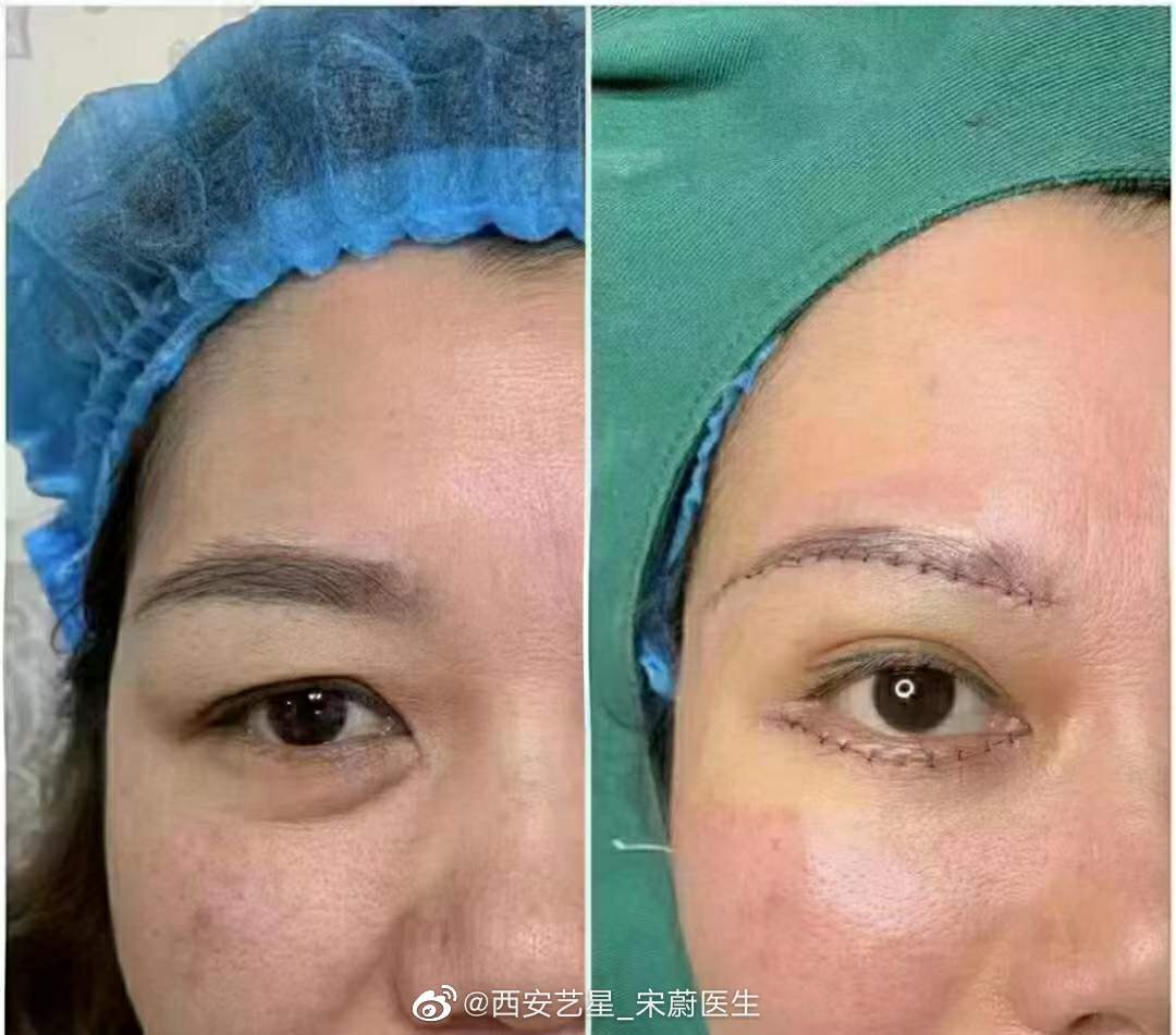 祛眼袋怎么选手术才不留疤?