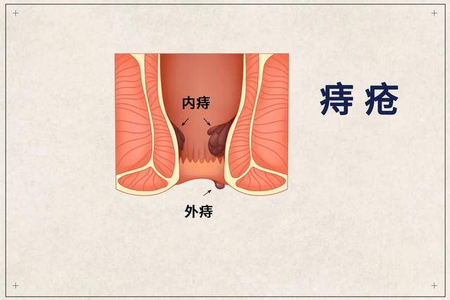 则称为内痔,当内痔受到粪便摩擦或其他外力挤压时就很可能出现破裂
