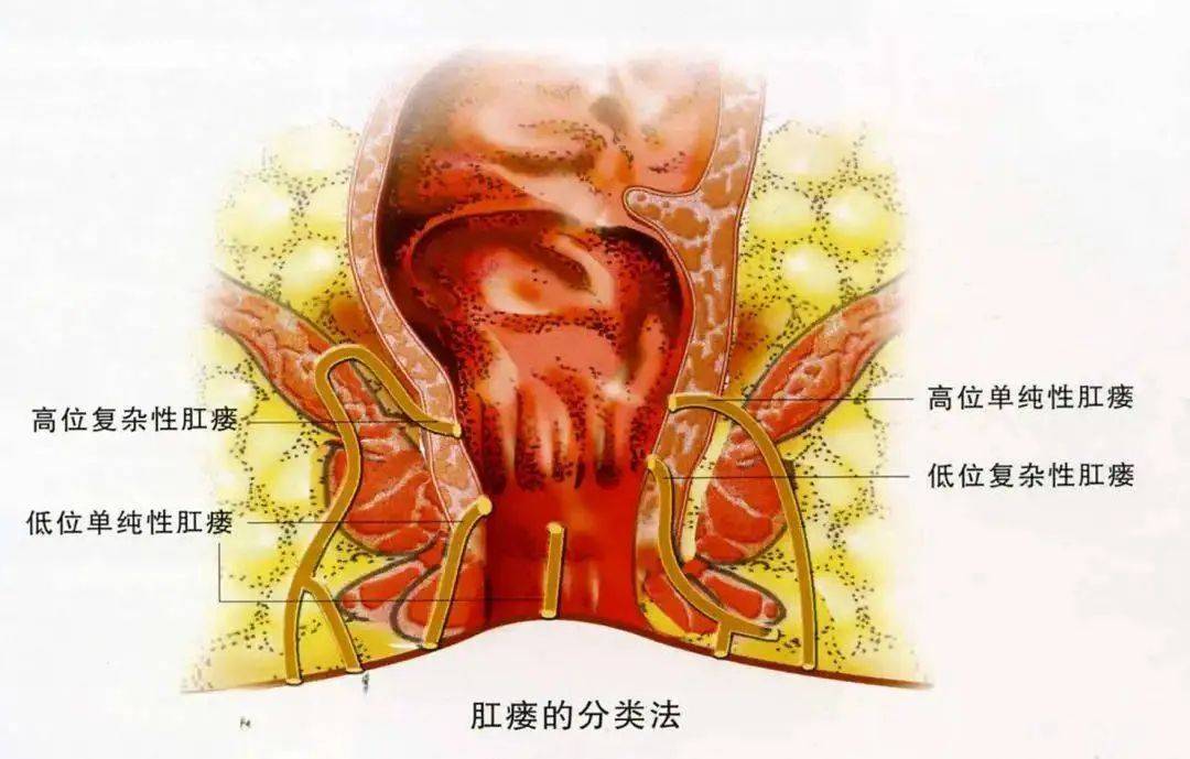 肛瘘切开术手术动画图片