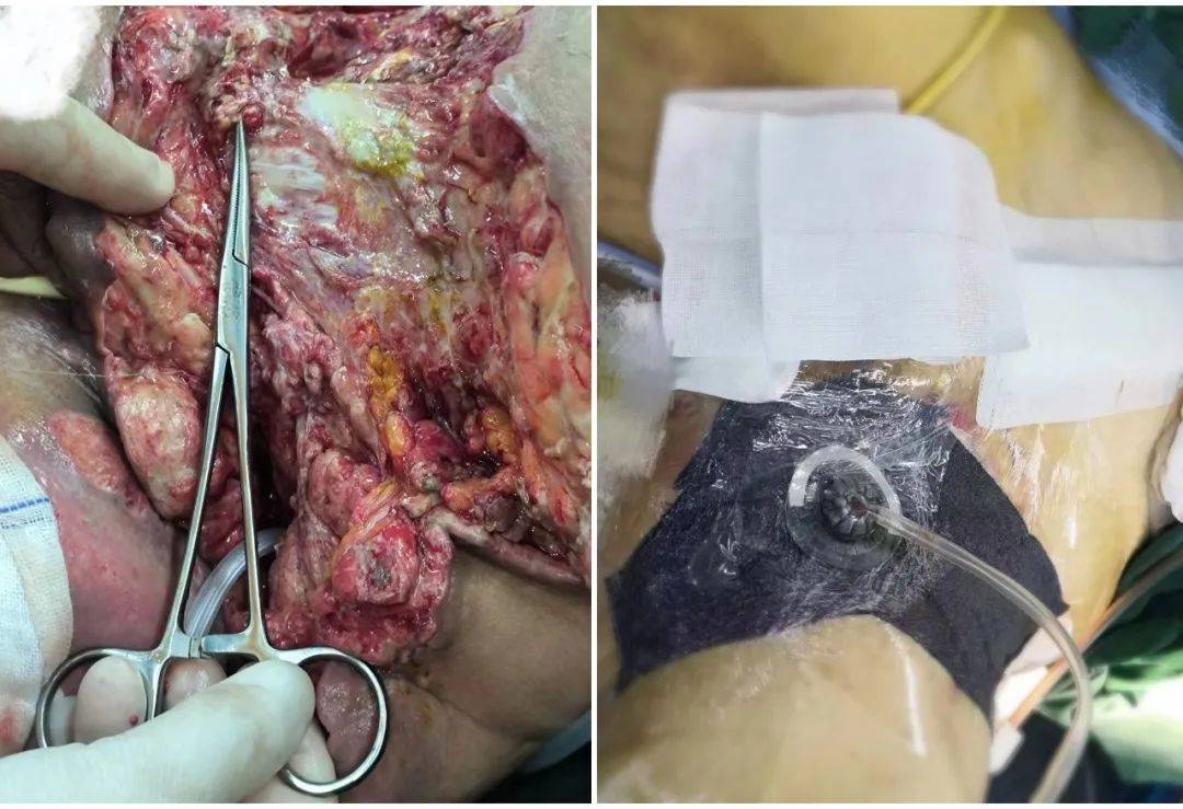 肛周脓肿手术后伤口图片