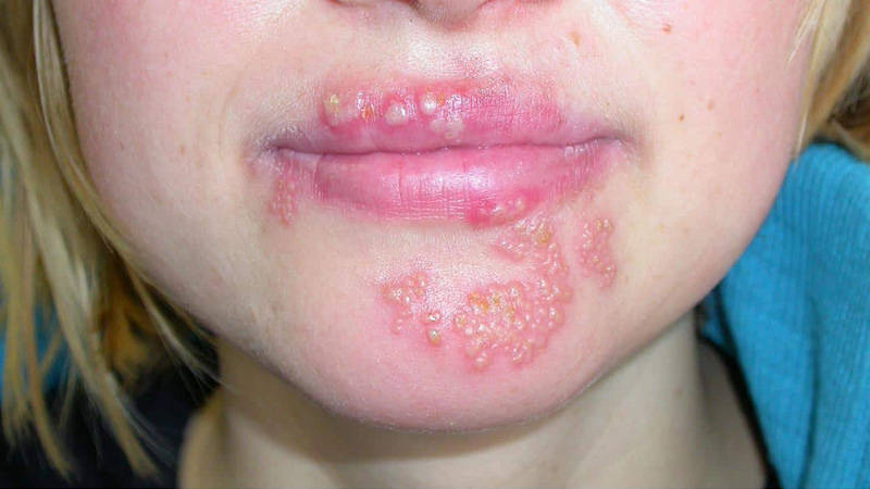 口唇疱疹自愈过程图片